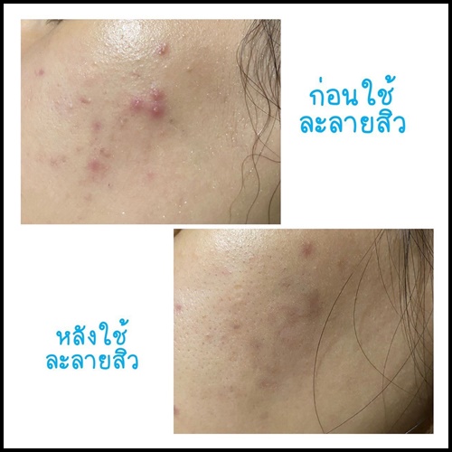 ฟาวเดอร์ เจลละลายสิว Founderskin Vitamin An-ti Acne