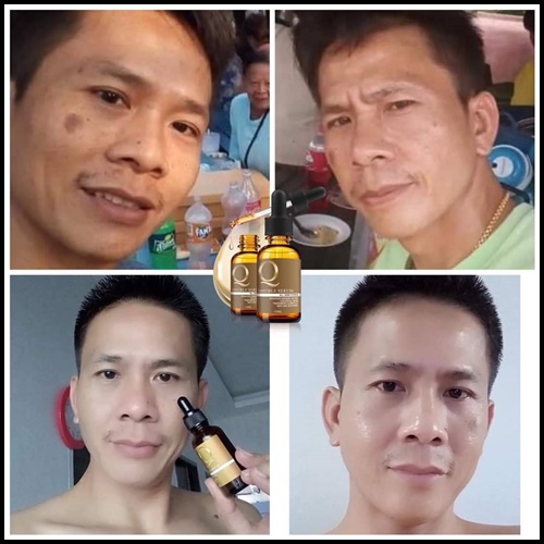 เซรั่ม Q Double Serum เซรั่มสลายฝ้า หน้าเด็ก (ของแท้ ส่งฟรี)