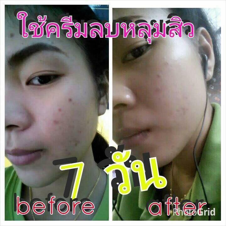 ชุดครีมลบหลุมสิว By Punlapa