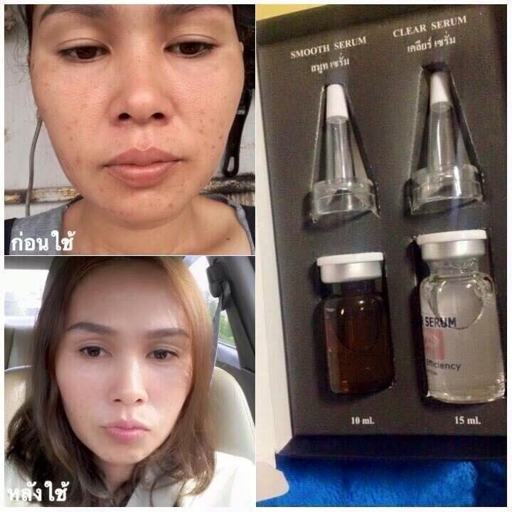 วิตามินเลเซอร์หน้าใส (Serum Vitamin Leser Beecute By BllnkBllnk)
