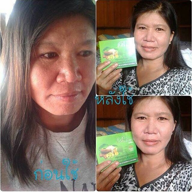 ครีมสมุนไพรมหัศจรรย์ บีเฮิร์บ (B Herb) สูตรใหม่