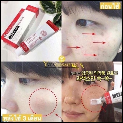 MEDI-PEEL melanon X cream หลอดสีแดง ลดฝ้า กระ จุดด่างดำ