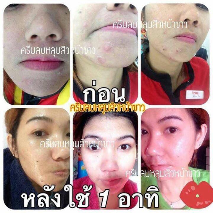 ชุดครีมลบหลุมสิว By Punlapa