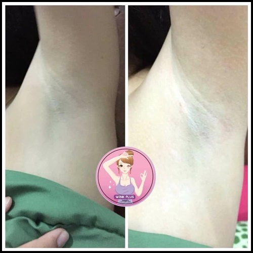 ครีมรักแร้ขาว Underarm Wink Plus