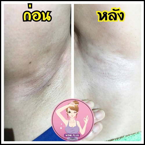 ครีมรักแร้ขาว Underarm Wink Plus