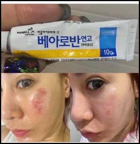 Bearoban Ointment ยาที่รักษาการอักเสบของผิว จากเกาหลี