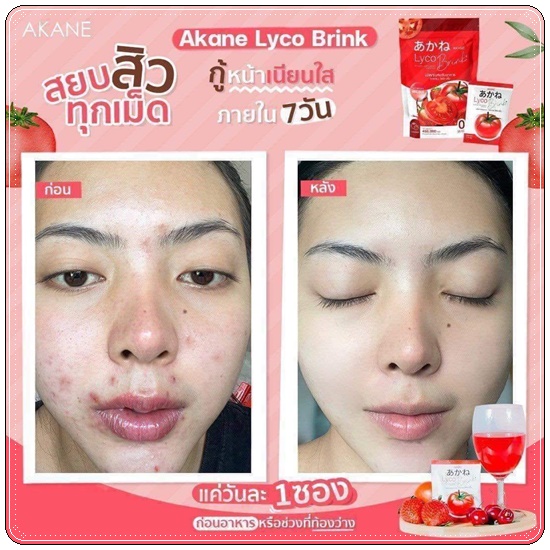 อากาเนะไลโคบริ้ง Akane Lyco Brink (ส่งฟรี)