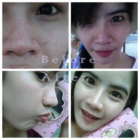 ครีมบล็อคสิว (skincare by anya)