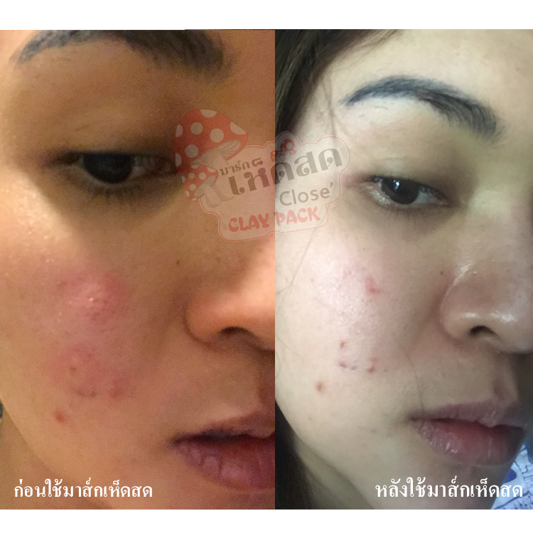 มาส์กเห็ดสดโกลด์ (Close clay pack Gold)