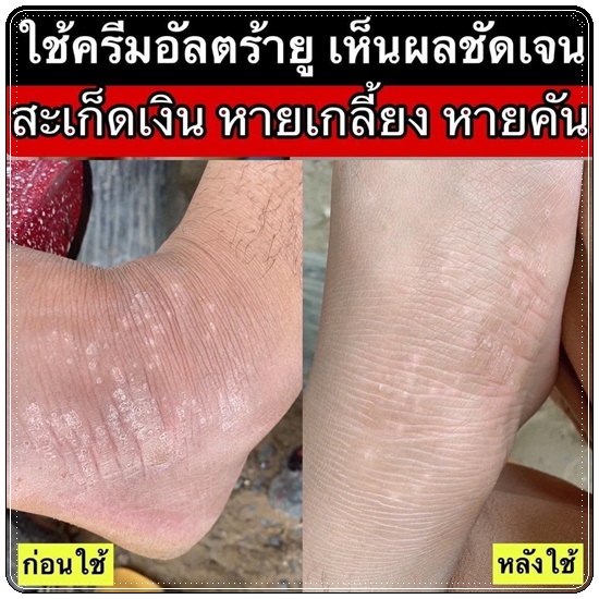 อัลตร้า ยู ครีม Ultra U Cream Natcha ลดอาการคัน กลากเกลื้อน