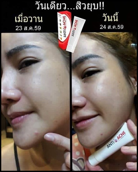 ครีมตบสิว Anti-Acne Massaging Cream By EVE's