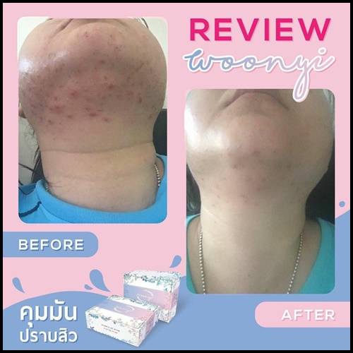 สบู่วุนยี Woonyi สบู่น้ำค้าง รักษาสิว