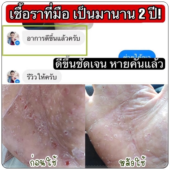อัลตร้า ยู ครีม Ultra U Cream Natcha ลดอาการคัน กลากเกลื้อน