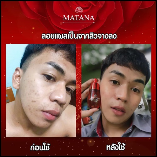 เซรั่มมัทนา Matana Angel Rose Drop Serum เซรั่มหยดกุหลาบนางฟ้า ของแท้ (ส่งฟรี)