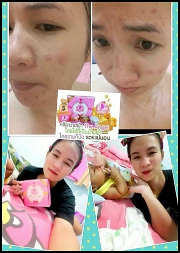 ครีมนางฟ้า The Angel Cream ครีมหน้าใส