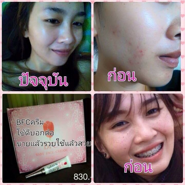 ครีม BFC Baby Face Cream ครีมหน้าใสรักษาสิว