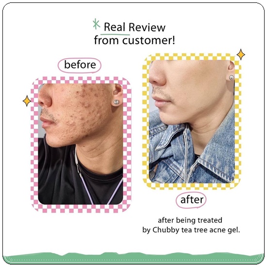 เจลแต้มสิวชับบี้ Chubby Tea Tree Acne Gel