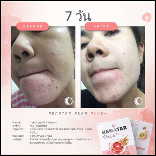 เรนาต้า ออร่าพลัส RENATAR AURA PLUS+ คอลลาเจนผิวใส