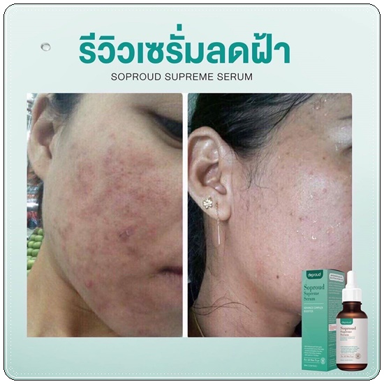 เซรั่มสลายฝ้า Soproud Supreme Serum deproud (ส่งฟรี)