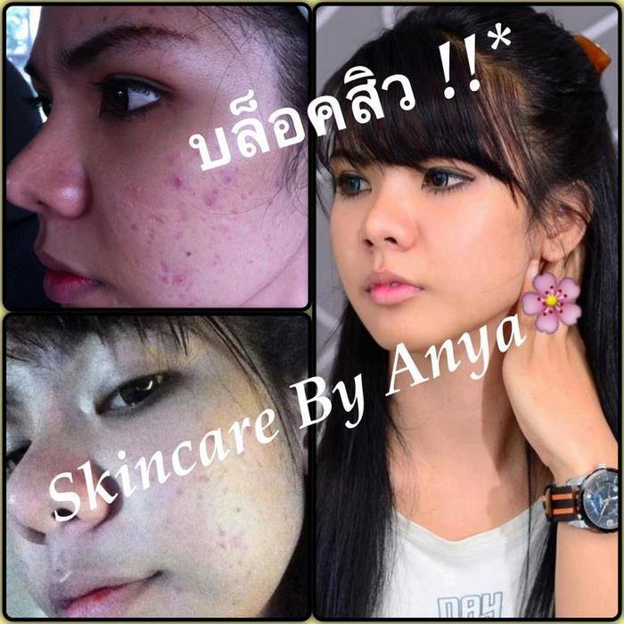 ครีมบล็อคสิว (skincare by anya)