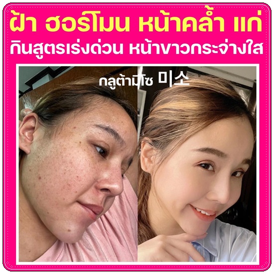 กลูต้ามีโซ Meeso Gluta (1แถม1)