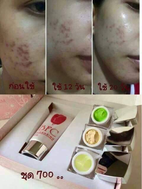 ครีม BFC Baby Face Cream ครีมหน้าใสรักษาสิว