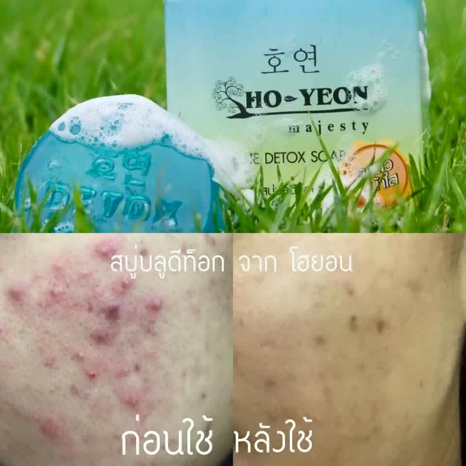สบู่บลูโฮยอน ดีท็อกซ์ (BLUE DETOX SOAP By โฮยอน)