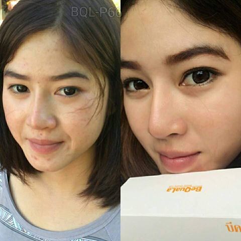 ครีมบีควอล่า(bequala) เซตเปลี่ยนหน้าสิวให้เป็นหน้าใส โปรฟรี EMS