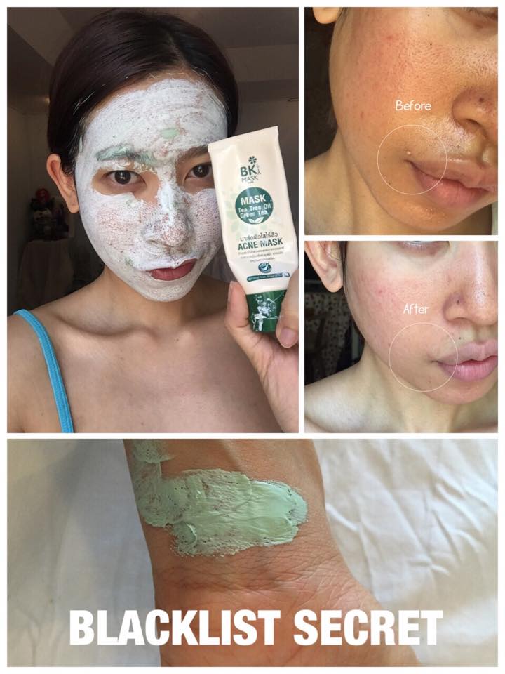 BK Acne Mask มาส์กปราบสิว