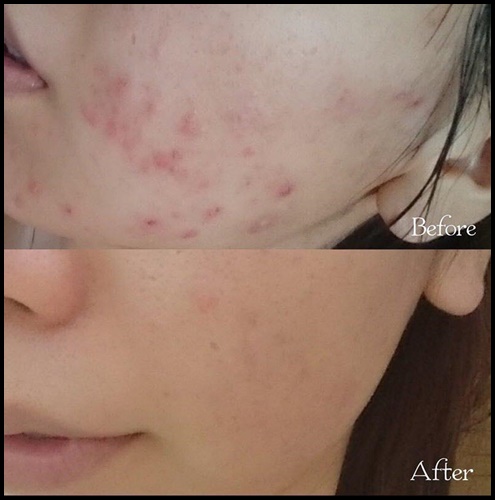 Bearoban Ointment ยาที่รักษาการอักเสบของผิว จากเกาหลี