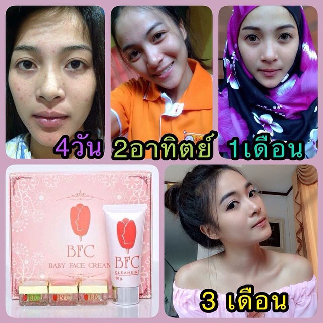 ครีม BFC Baby Face Cream ครีมหน้าใสรักษาสิว