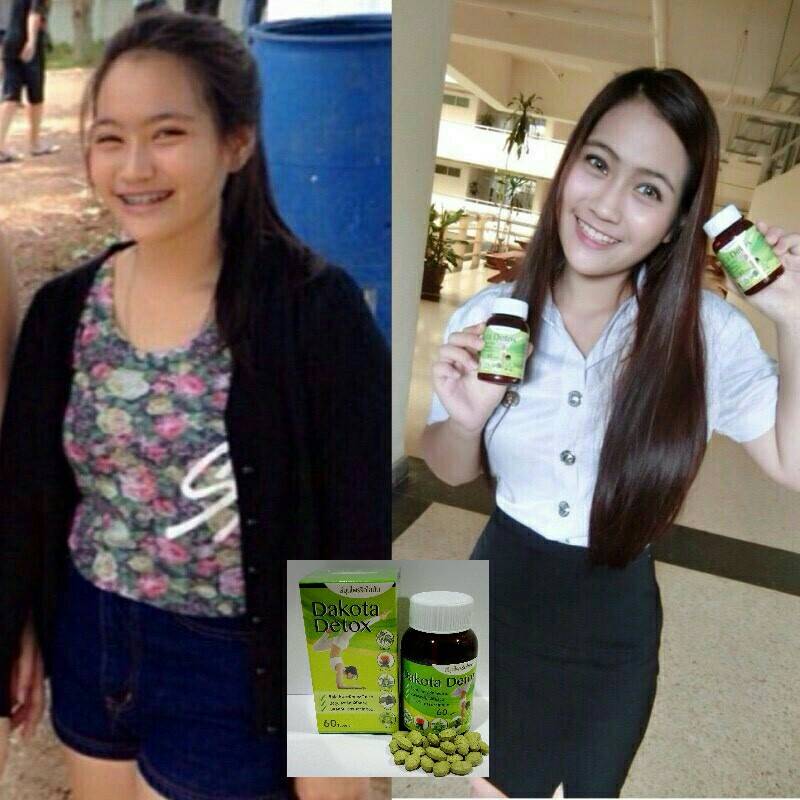 ดาโกต้า ดีท็อกซ์ สมุนไพรรีดไขมัน (Dakota Detox)