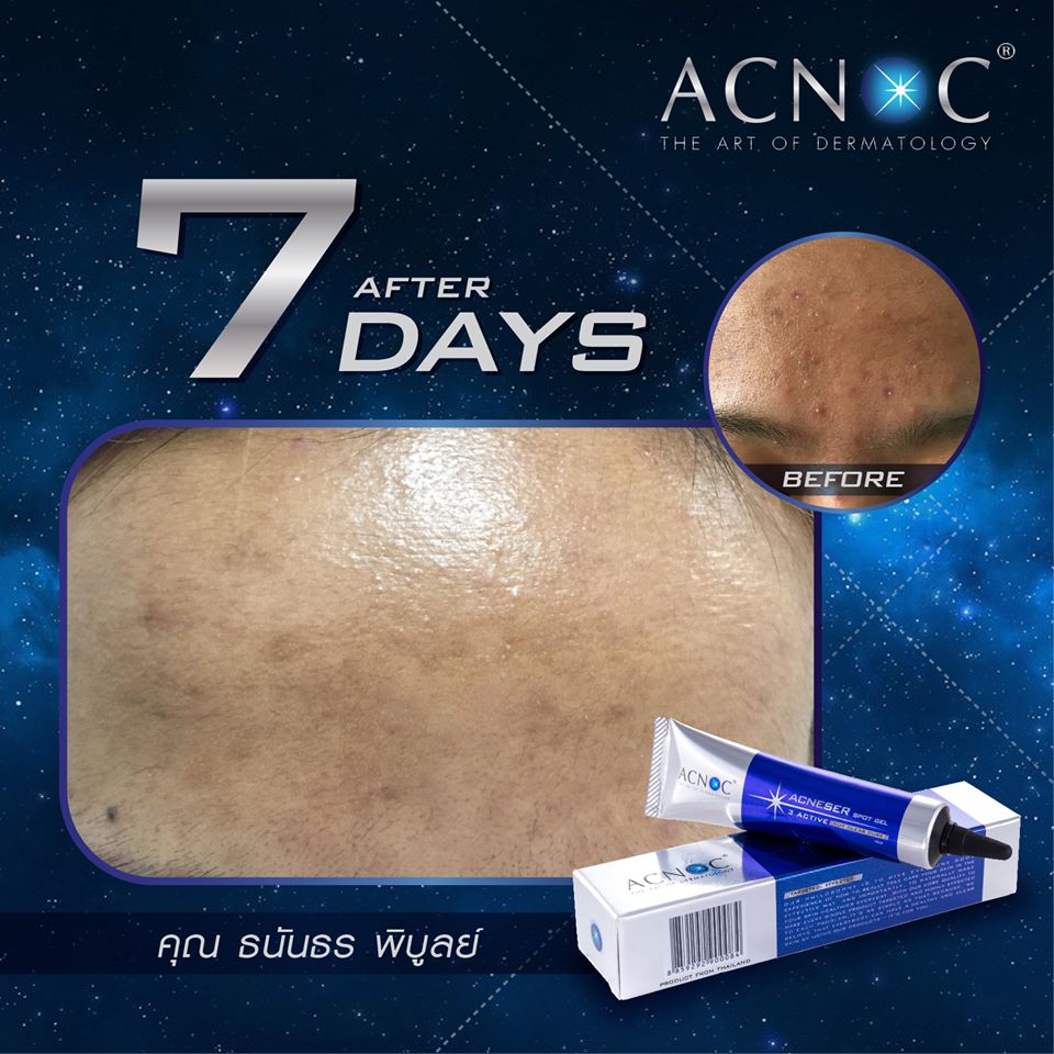 เจลแต้มสิว ACNOC - Acneser Spot Gel