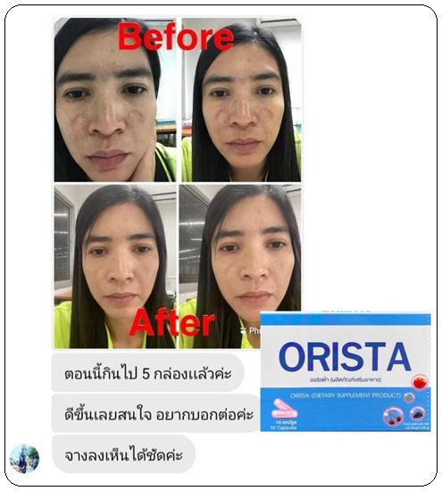 ออริสต้าพลัส ORISTA Plus สูตรใหม่ วิตามินรักษาฝ้า