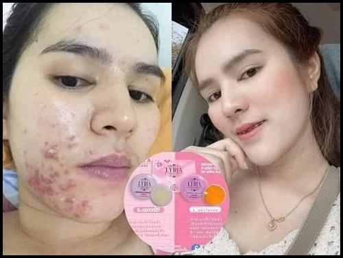 ครีมลิเดีย Lydia Cream ครีมรักษา สิว ฝ้า กระ แพคเกจใหม่