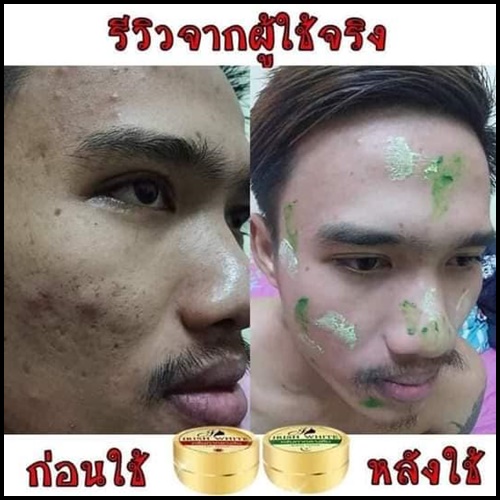 IRish White + Mira Serum เซตรักษาสิว ผิวขาวใส