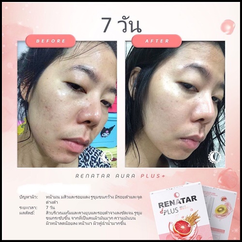 เรนาต้า ออร่าพลัส RENATAR AURA PLUS+ คอลลาเจนผิวใส