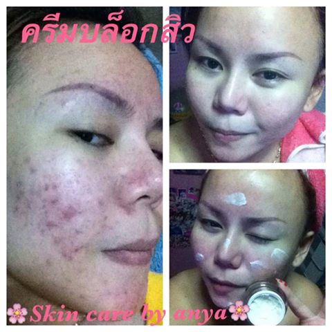 ครีมบล็อคสิว (skincare by anya)