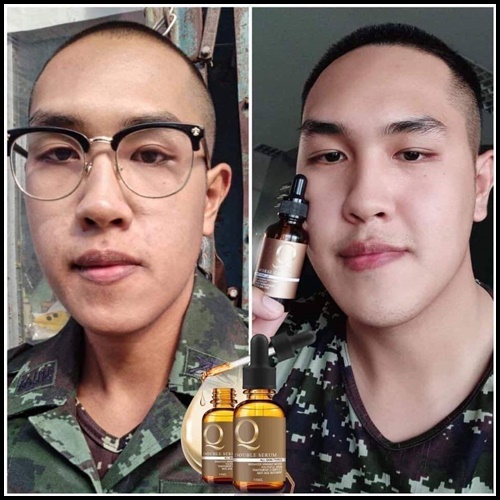 เซรั่ม Q Double Serum เซรั่มสลายฝ้า หน้าเด็ก (ของแท้ ส่งฟรี)