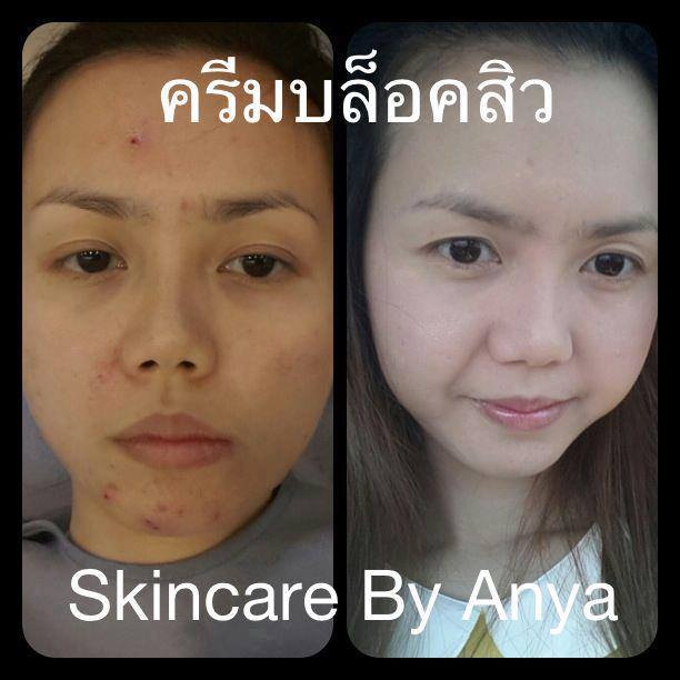 ครีมบล็อคสิว (skincare by anya)