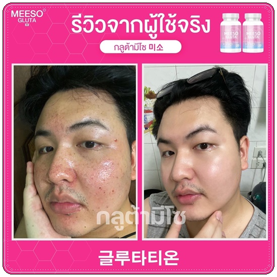กลูต้ามีโซ Meeso Gluta (1แถม1)