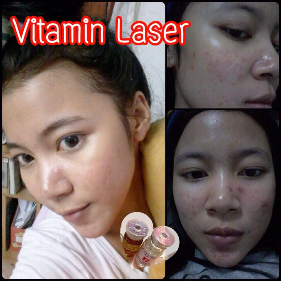 วิตามินเลเซอร์หน้าใส (Serum Vitamin Leser Beecute By BllnkBllnk)