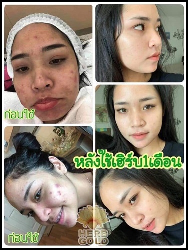 ครีมสมุนไพร เฮิร์บ โกล Herb Gold by Herb inside โฉมใหม่