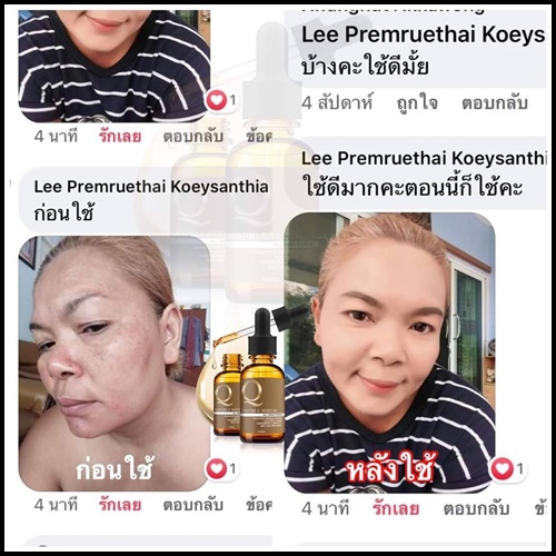 เซรั่ม Q Double Serum เซรั่มสลายฝ้า หน้าเด็ก (ของแท้ ส่งฟรี)