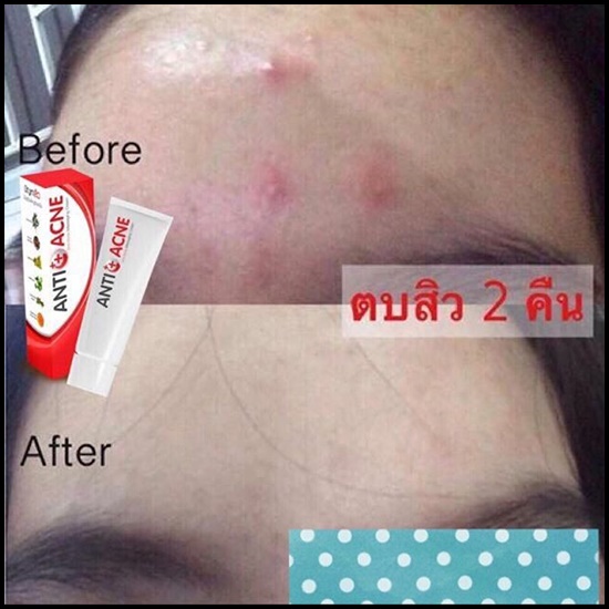 ครีมตบสิว Anti-Acne Massaging Cream By EVE's