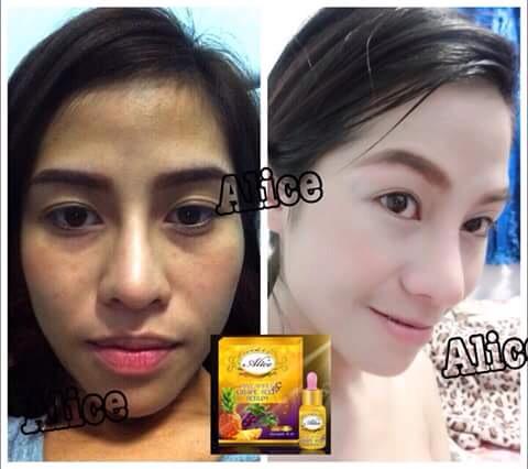 เซรั่มสับปะรด&องุ่น (เซรั่มเทพหน้าใส Pineapple & Grape Seed Serum)