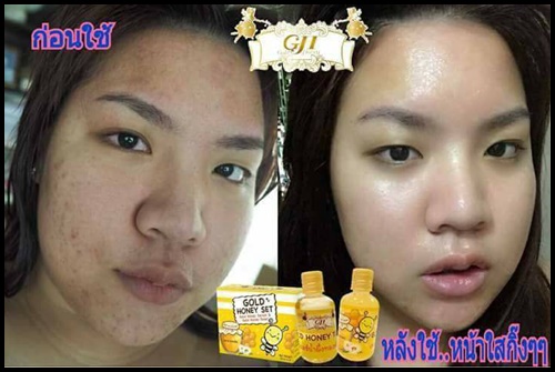 โกล ฮันนี่ เซต Gold Honey Set ตบฝ้า หน้าใส ฆ่าสิว