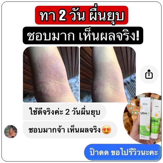 อัลตร้า ยู ครีม Ultra U Cream Natcha ลดอาการคัน กลากเกลื้อน