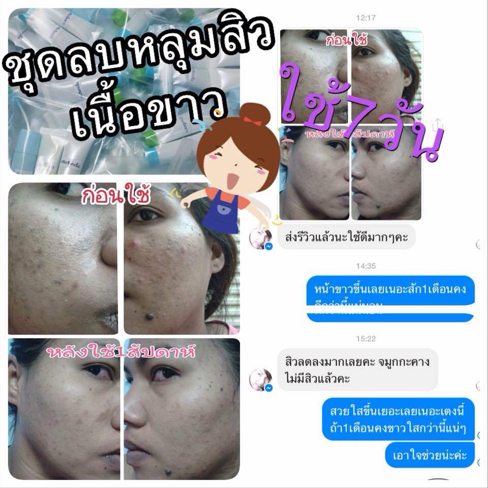 ชุดครีมลบหลุมสิว By Punlapa