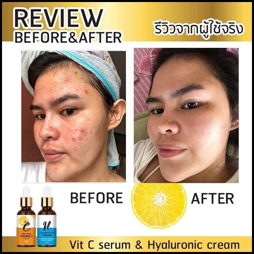 ไฮยาลูรอน เอซิด ครีม Hyaluronic Acid Cream